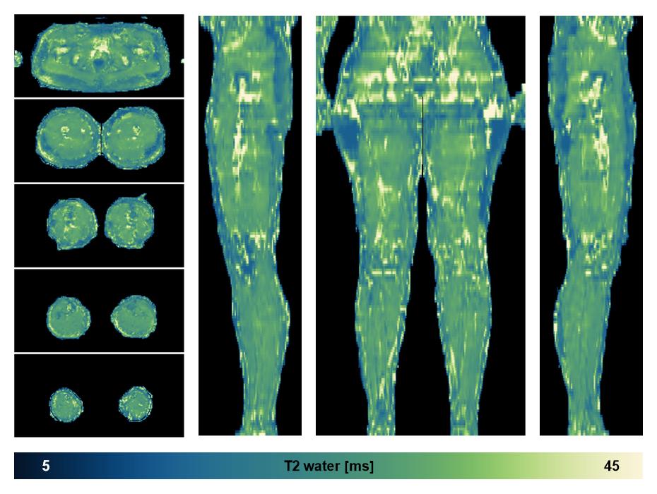 The water only T2 relaxation time of the lower extremity obtained from multi echo spin echo t2 mapping with EPG based reconstruction.