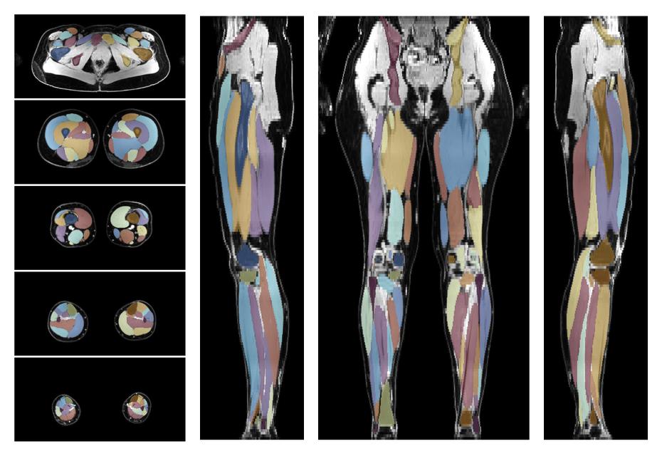 Overlay of automated muscle segmentation labels on dixon water image.