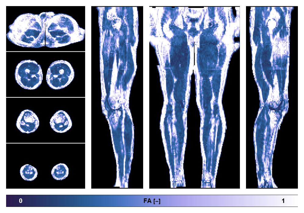 IVIM corrected whole leg muscle fractional anisotropy obtained from diffusion tensor imaging.