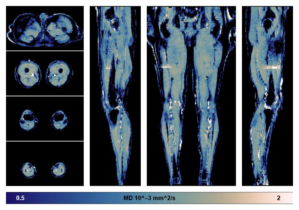 IVIM corrected whole leg muscle mean diffusivity obtained from diffusion tensor imaging.