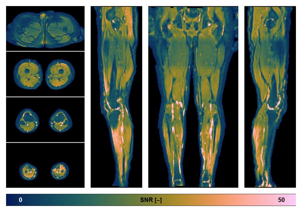 SNR distribution of the unweighted diffusion data.