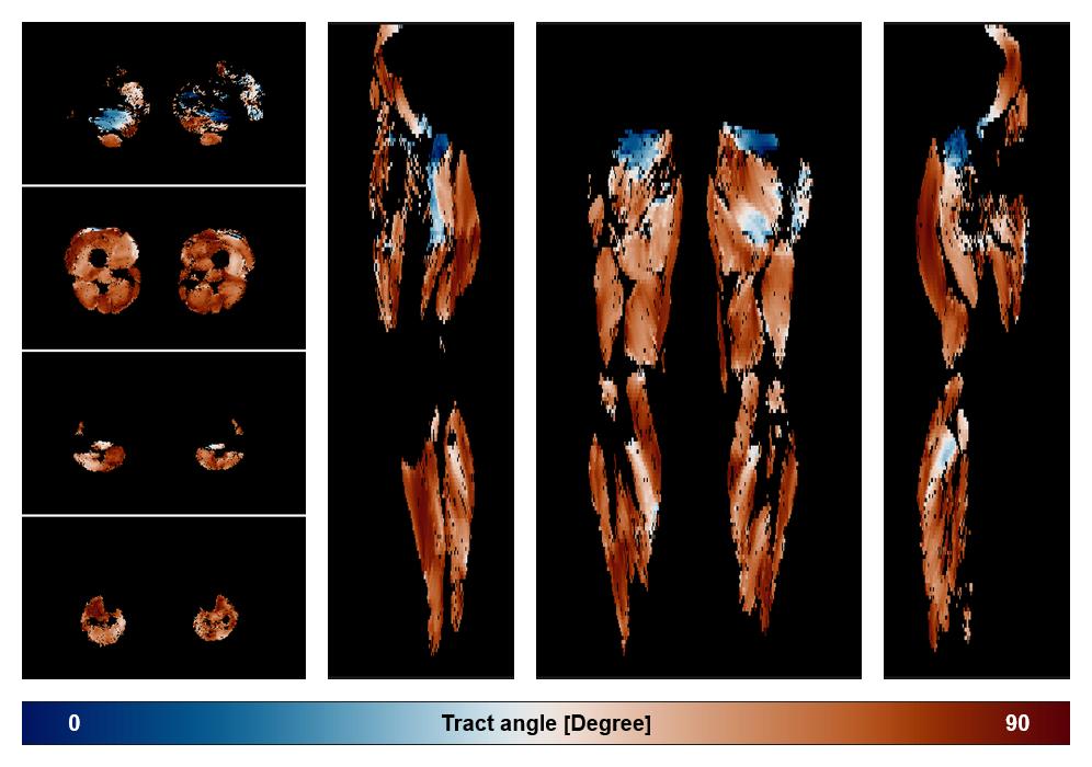 Muscle fiber tract angle map based on whole leg DTI based fiber tractography.