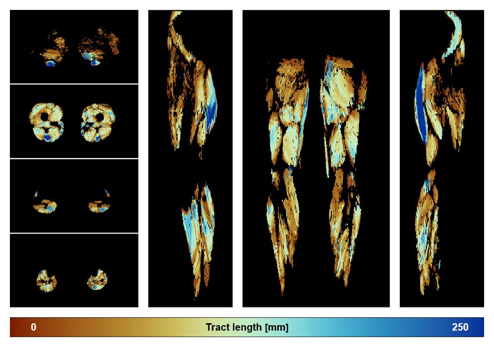 Muscle fiber tract length map based on whole leg DTI based fiber tractography.