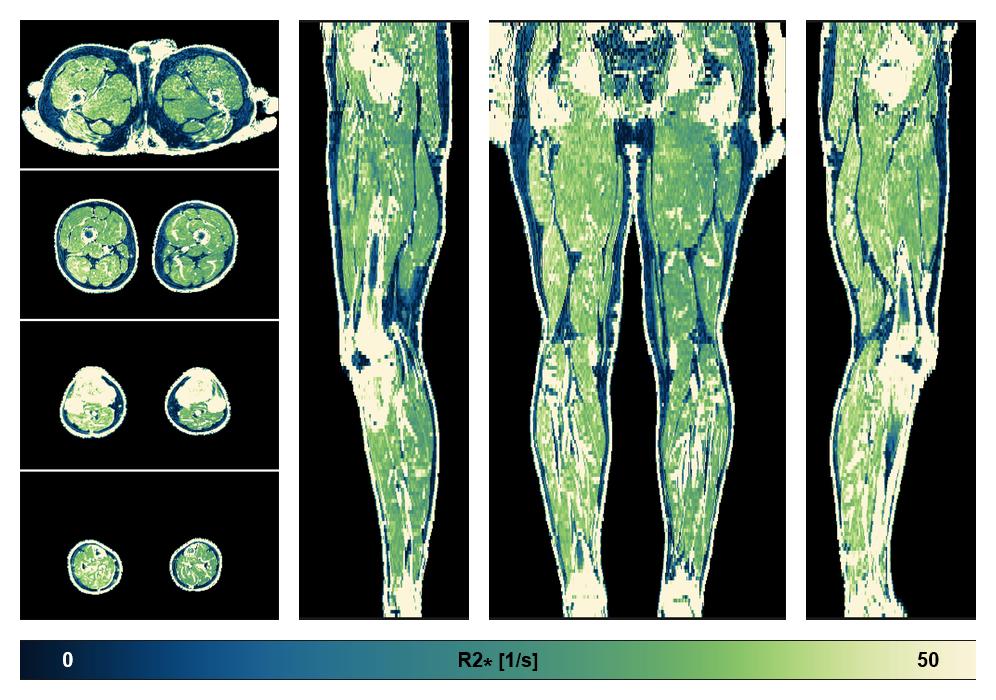 The R2 star relaxation time of the lower extremity obtained from the dixon reconstruction for muscle water fat quantification.
