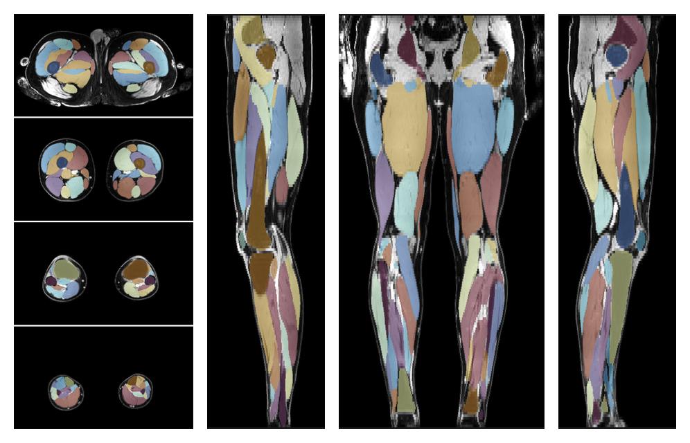 Overlay of automated muscle segmentation labels on dixon water image.
