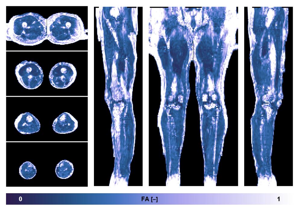 IVIM corrected whole leg muscle fractional anisotropy obtained from diffusion tensor imaging.