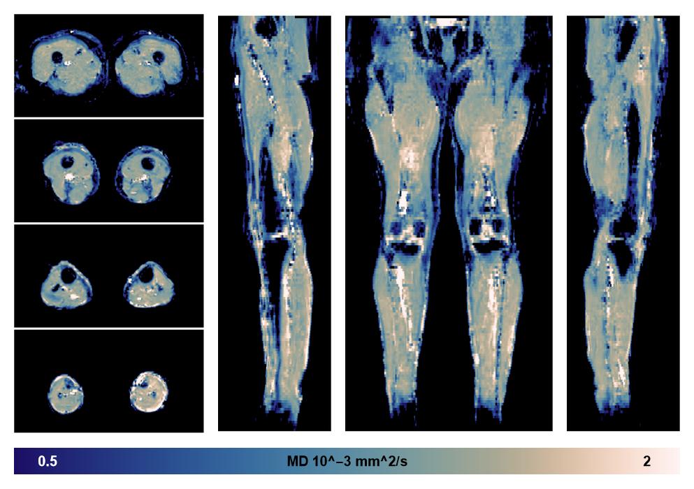 IVIM corrected whole leg muscle mean diffusivity obtained from diffusion tensor imaging.