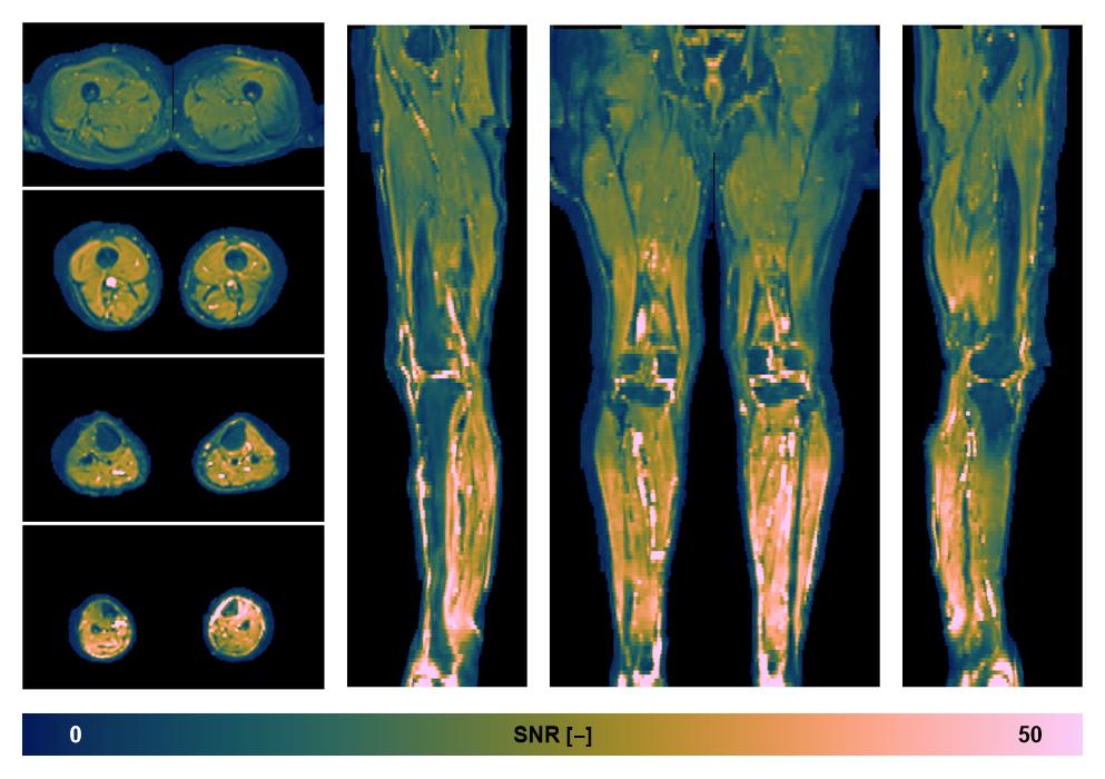 SNR distribution of the unweighted diffusion data.