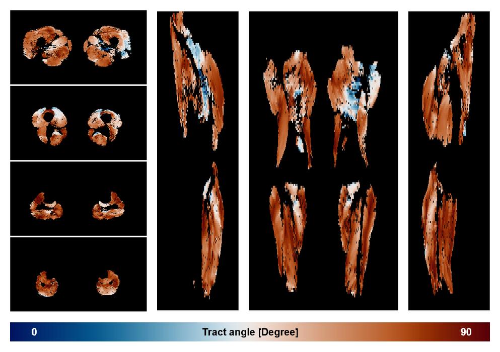 Muscle fiber tract angle map based on whole leg DTI based fiber tractography.