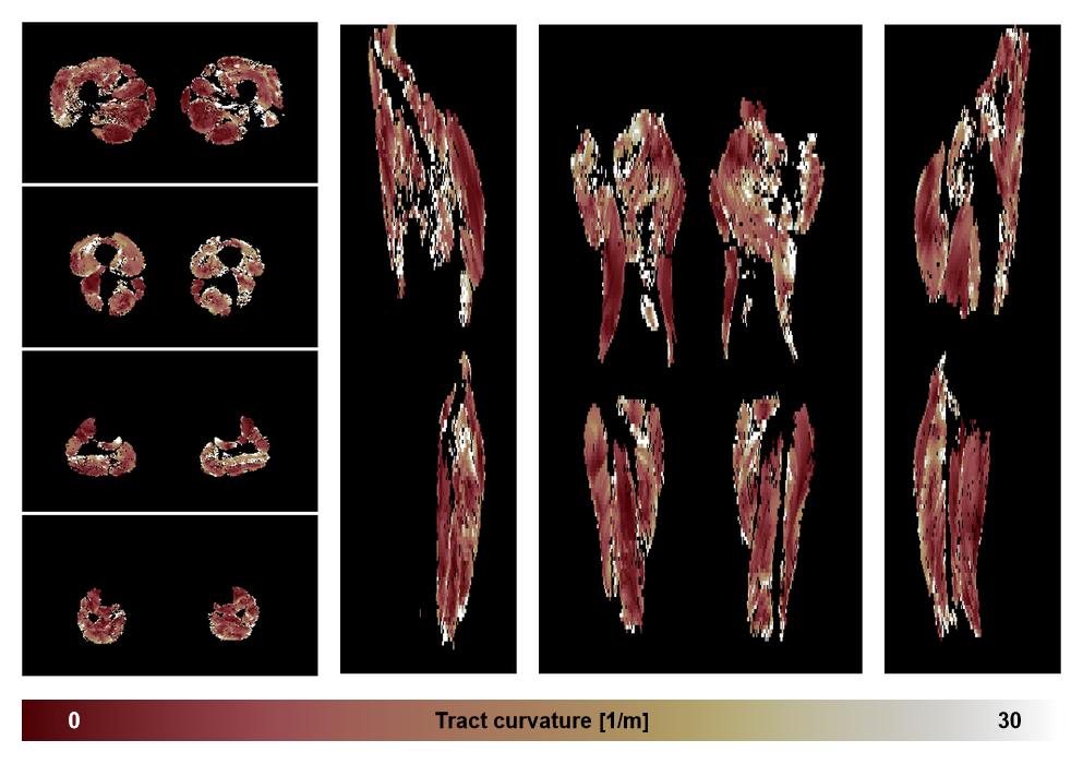 Muscle fiber tract curvature map based on whole leg DTI based fiber tractography.