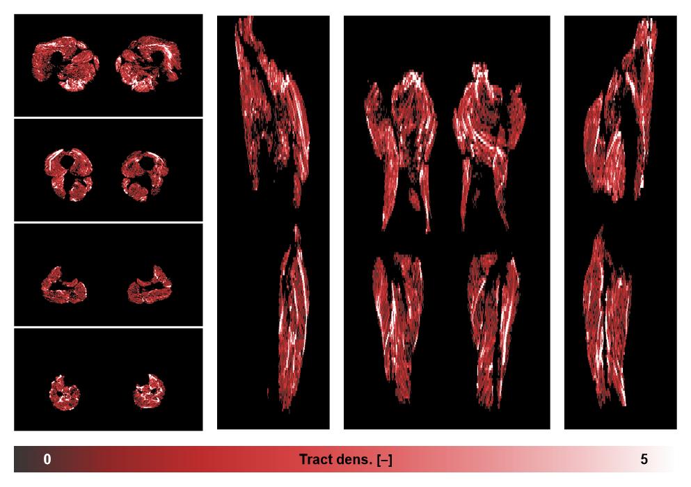 Muscle fiber tract density map based on whole leg DTI based fiber tractography.