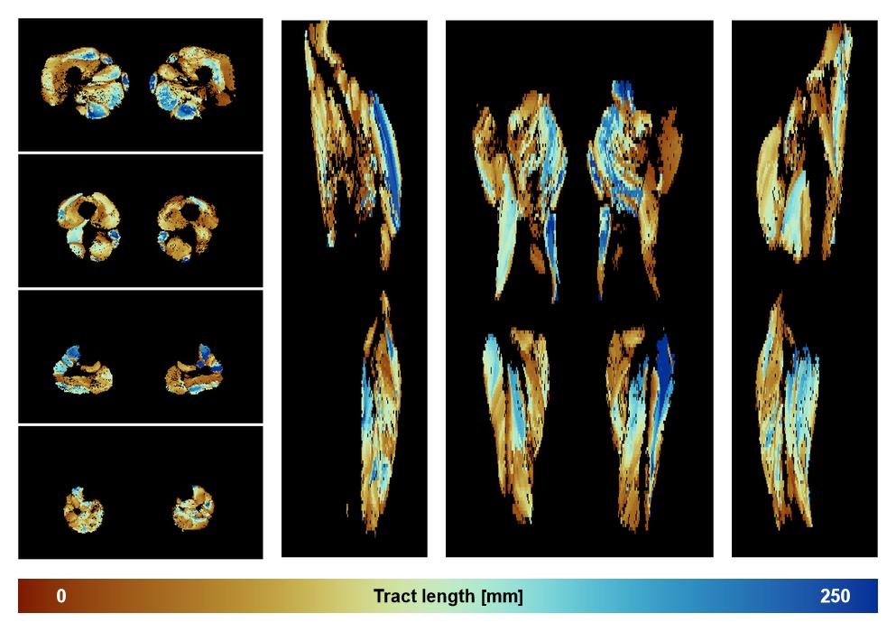 Muscle fiber tract length map based on whole leg DTI based fiber tractography.