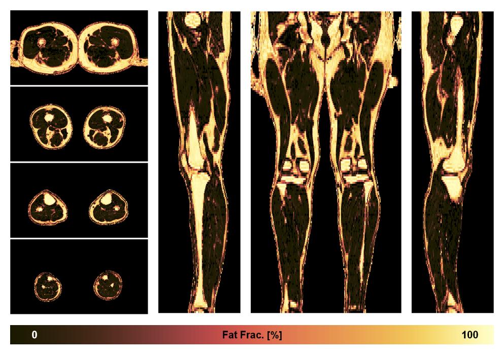 The fat fraction of the lower extremity obtained from the dixon reconstruction for muscle water fat quantification.