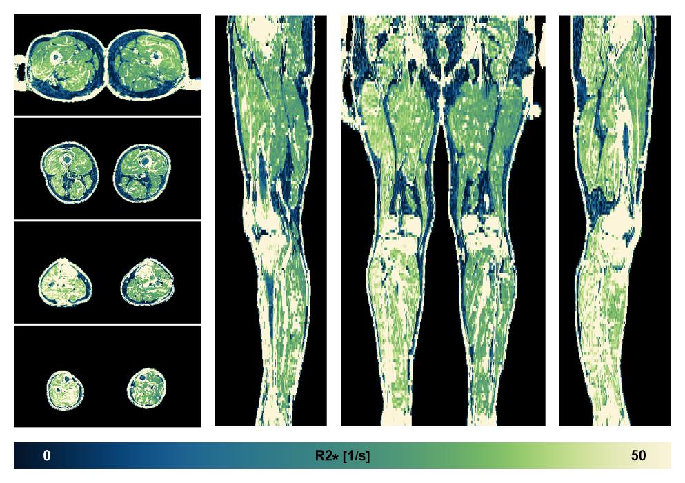 The R2 star relaxation time of the lower extremity obtained from the dixon reconstruction for muscle water fat quantification.