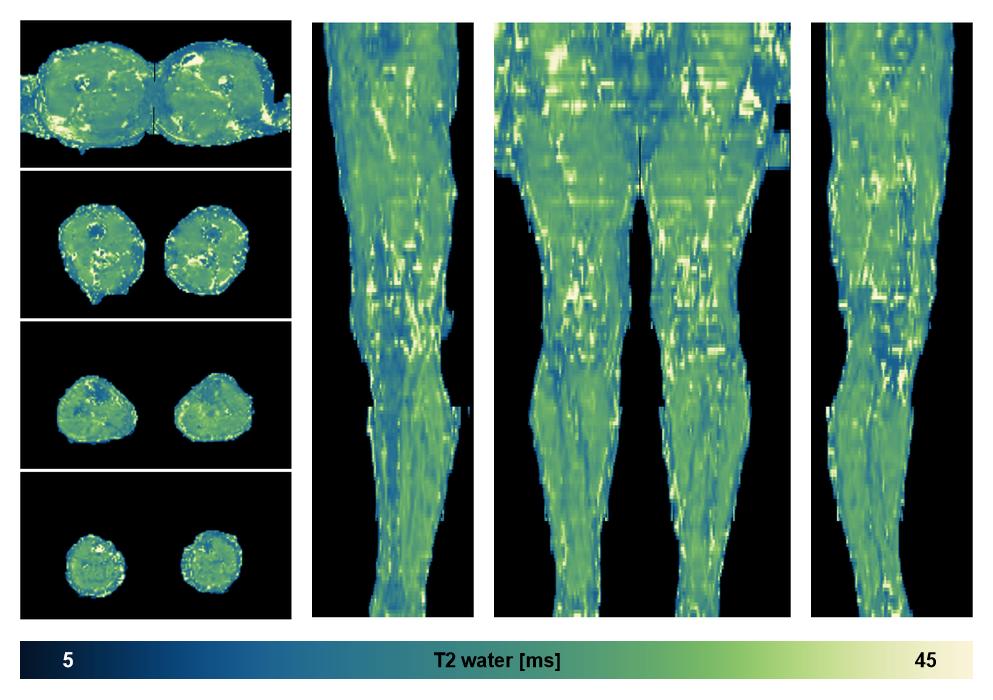 The water only T2 relaxation time of the lower extremity obtained from multi echo spin echo t2 mapping with EPG based reconstruction.