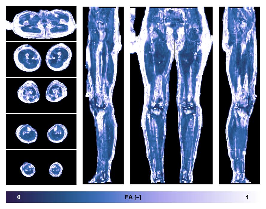 IVIM corrected whole leg muscle fractional anisotropy obtained from diffusion tensor imaging.