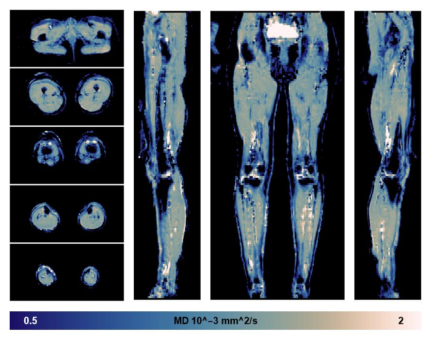 IVIM corrected whole leg muscle mean diffusivity obtained from diffusion tensor imaging.