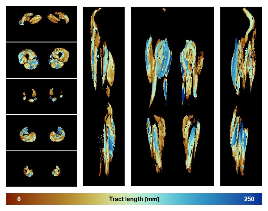 Muscle fiber tract length map based on whole leg DTI based fiber tractography.