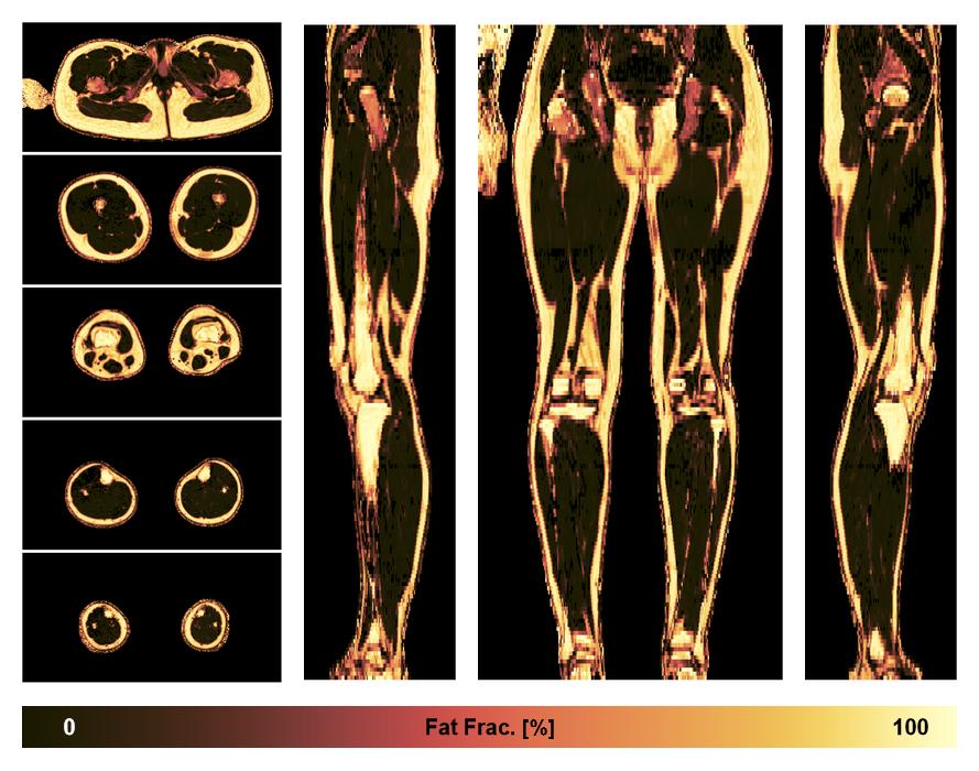 The fat fraction of the lower extremity obtained from the dixon reconstruction for muscle water fat quantification.