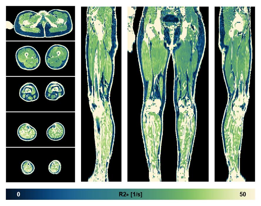 The R2 star relaxation time of the lower extremity obtained from the dixon reconstruction for muscle water fat quantification.
