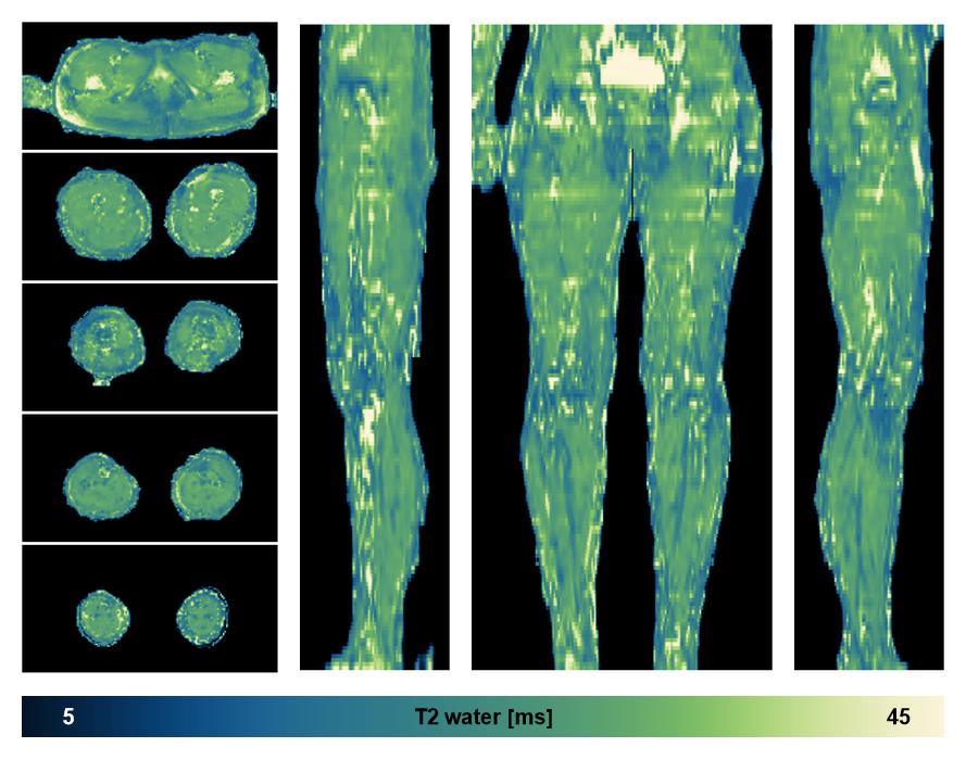 The water only T2 relaxation time of the lower extremity obtained from multi echo spin echo t2 mapping with EPG based reconstruction.