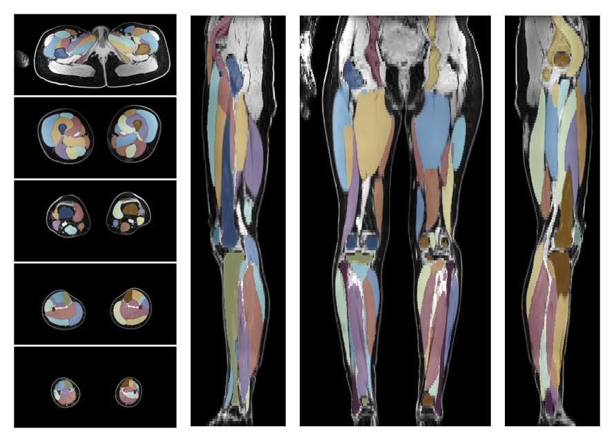 Overlay of automated muscle segmentation labels on dixon water image.