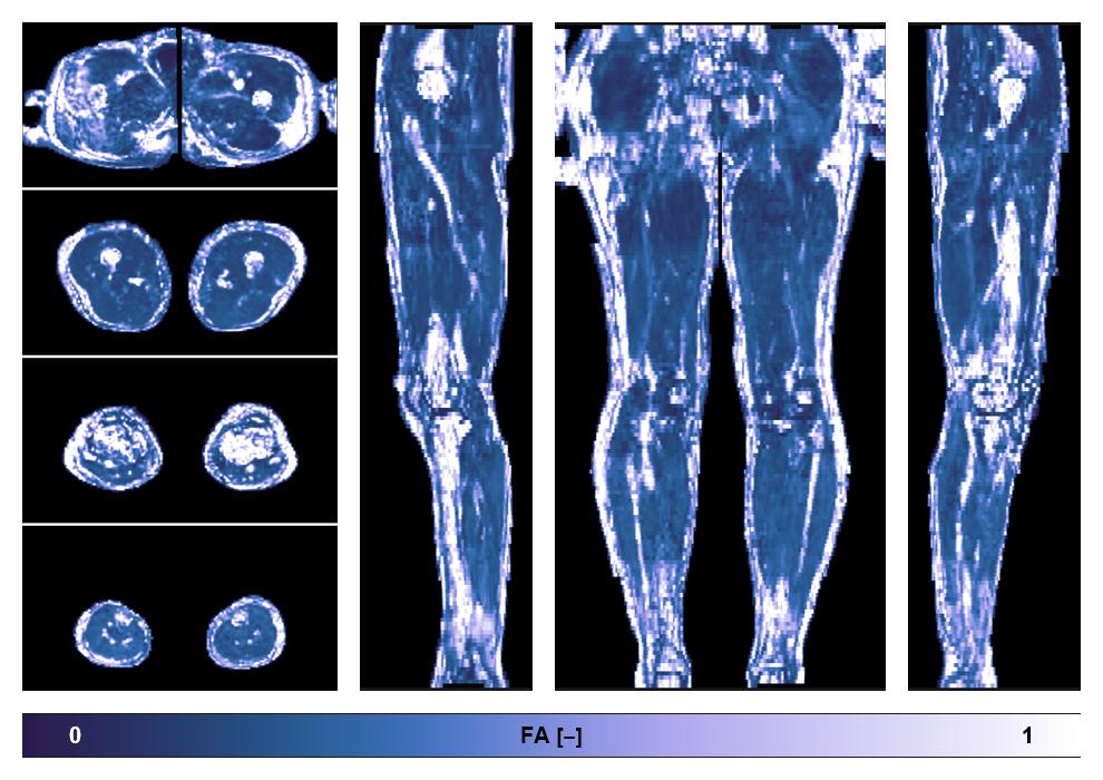 IVIM corrected whole leg muscle fractional anisotropy obtained from diffusion tensor imaging.