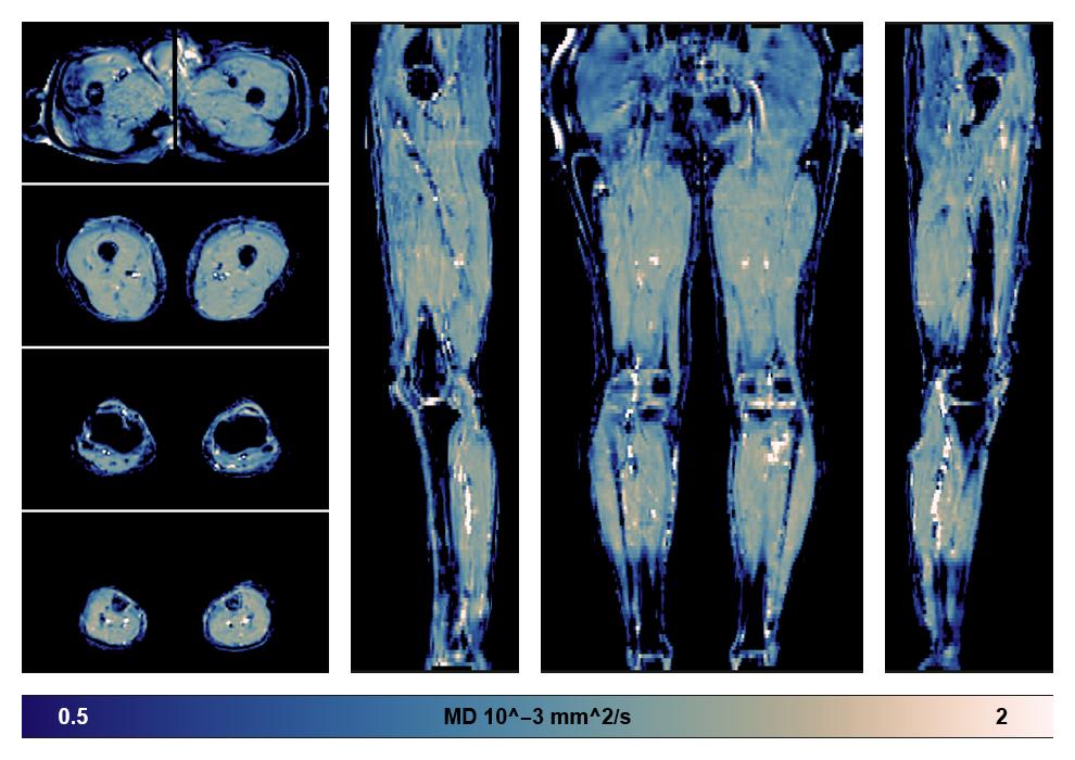 IVIM corrected whole leg muscle mean diffusivity obtained from diffusion tensor imaging.