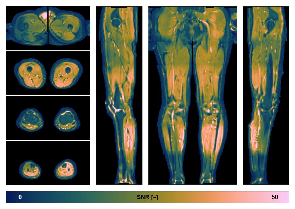 SNR distribution of the unweighted diffusion data.