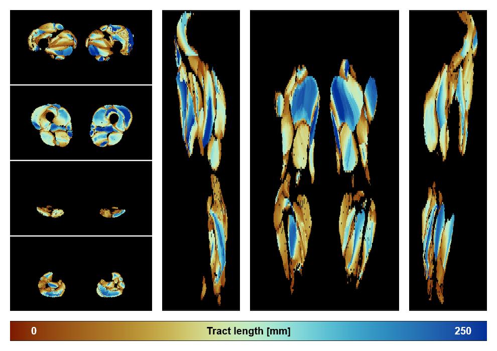 Muscle fiber tract length map based on whole leg DTI based fiber tractography.