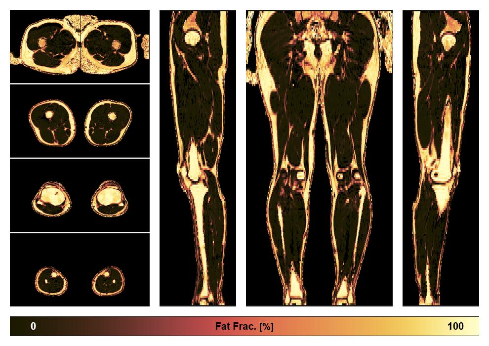 The fat fraction of the lower extremity obtained from the dixon reconstruction for muscle water fat quantification.