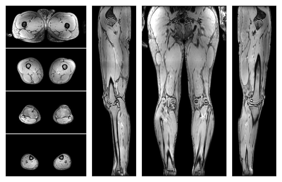 The out-phase image of the dixon reconstruction for water fat quantification.