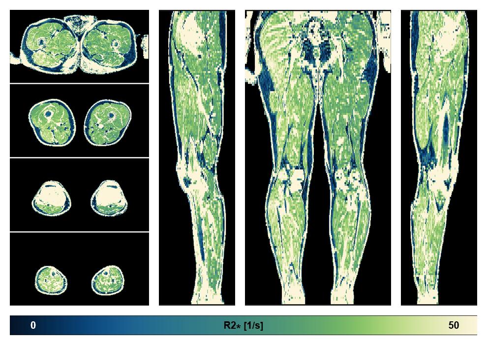 The R2 star relaxation time of the lower extremity obtained from the dixon reconstruction for muscle water fat quantification.