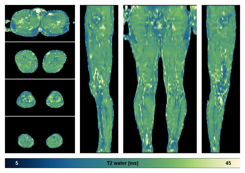 The water only T2 relaxation time of the lower extremity obtained from multi echo spin echo t2 mapping with EPG based reconstruction.