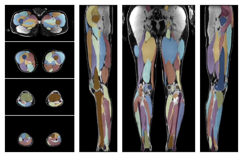 Overlay of automated muscle segmentation labels on dixon water image.
