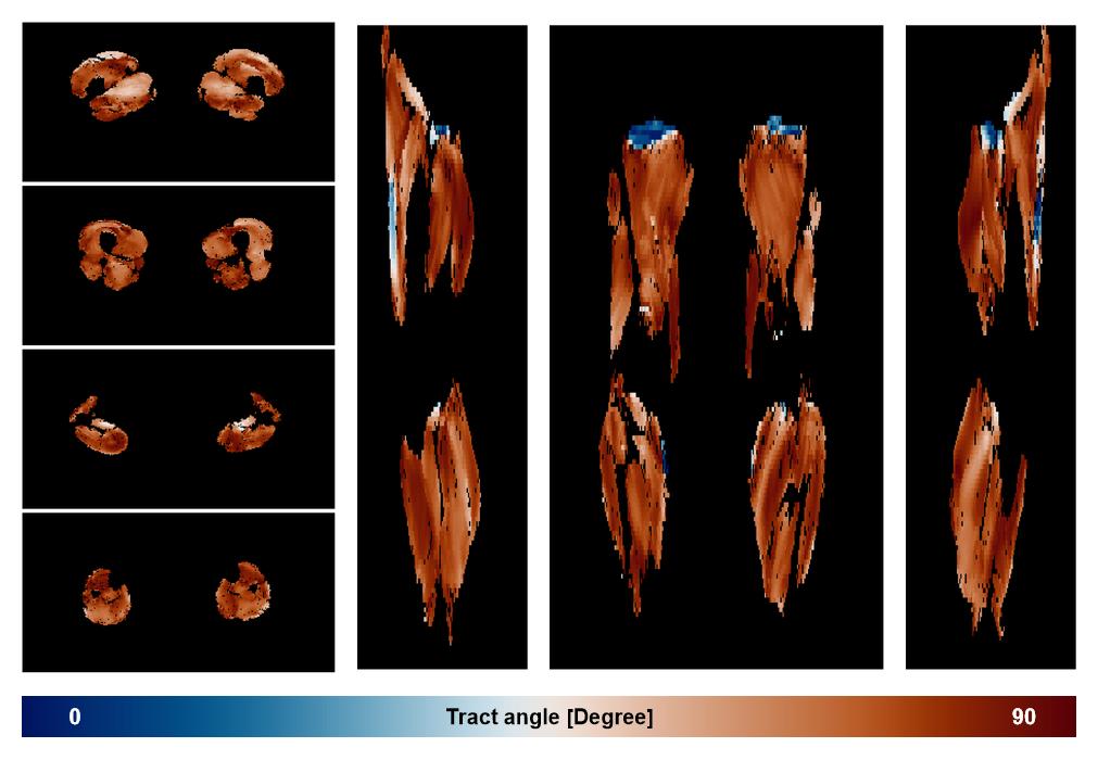 Muscle fiber tract angle map based on whole leg DTI based fiber tractography.