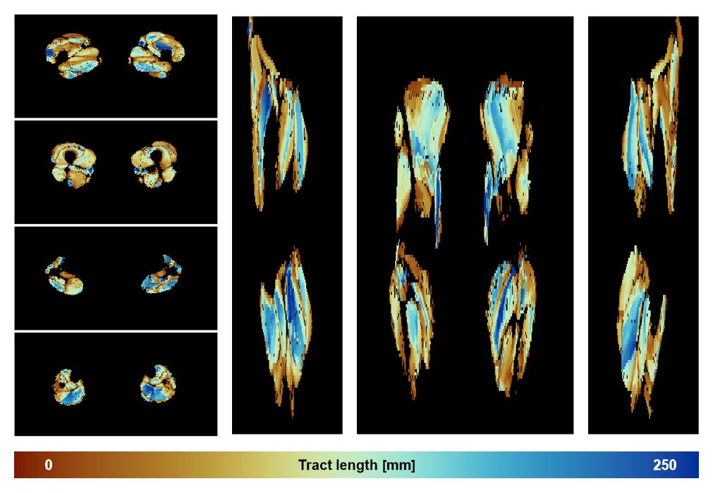 Muscle fiber tract length map based on whole leg DTI based fiber tractography.
