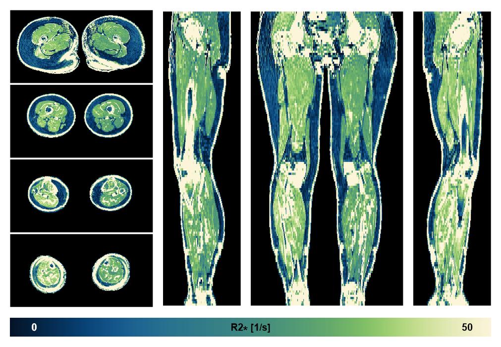 The R2 star relaxation time of the lower extremity obtained from the dixon reconstruction for muscle water fat quantification.
