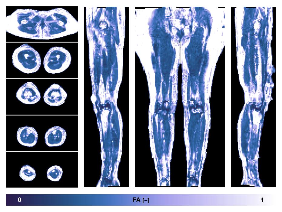 IVIM corrected whole leg muscle fractional anisotropy obtained from diffusion tensor imaging.