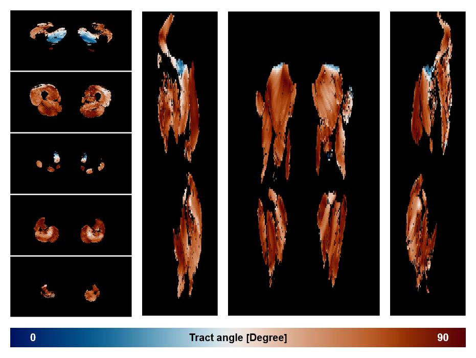 Muscle fiber tract angle map based on whole leg DTI based fiber tractography.