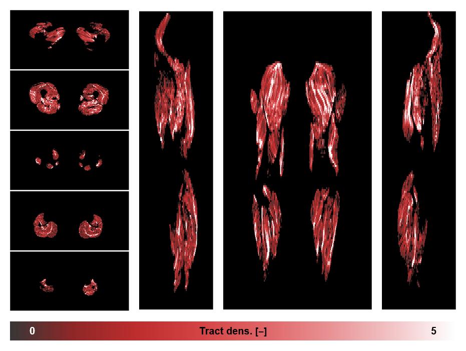Muscle fiber tract density map based on whole leg DTI based fiber tractography.