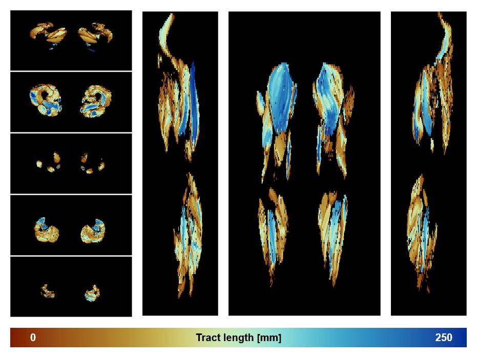 Muscle fiber tract length map based on whole leg DTI based fiber tractography.