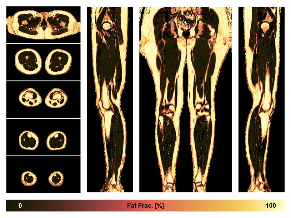 The fat fraction of the lower extremity obtained from the dixon reconstruction for muscle water fat quantification.