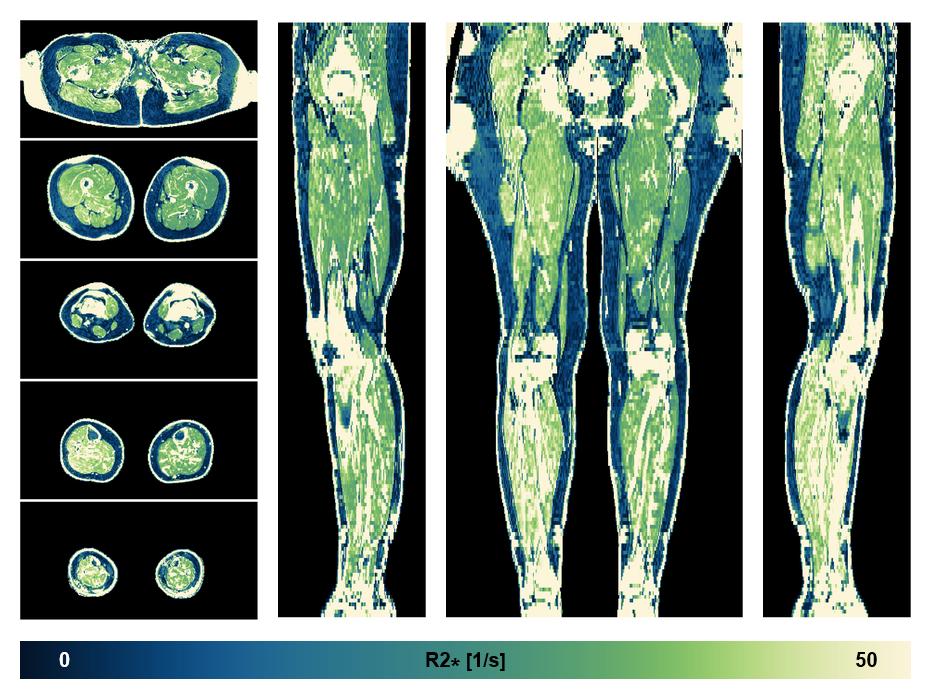 The R2 star relaxation time of the lower extremity obtained from the dixon reconstruction for muscle water fat quantification.