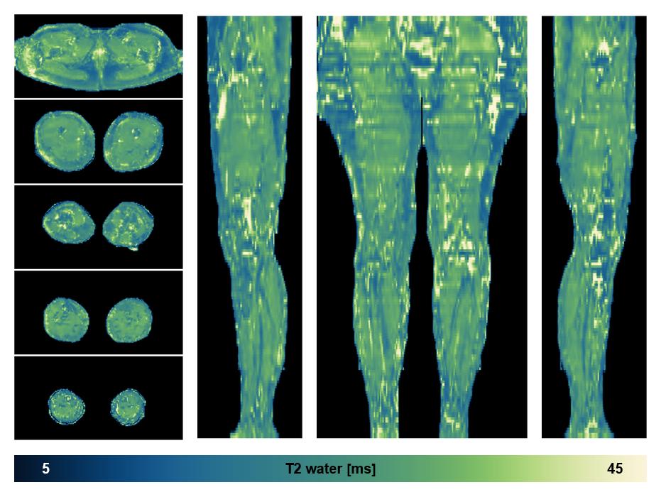 The water only T2 relaxation time of the lower extremity obtained from multi echo spin echo t2 mapping with EPG based reconstruction.