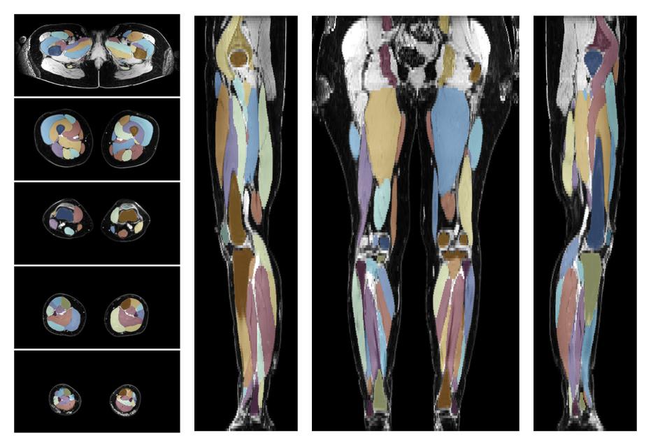 Overlay of automated muscle segmentation labels on dixon water image.