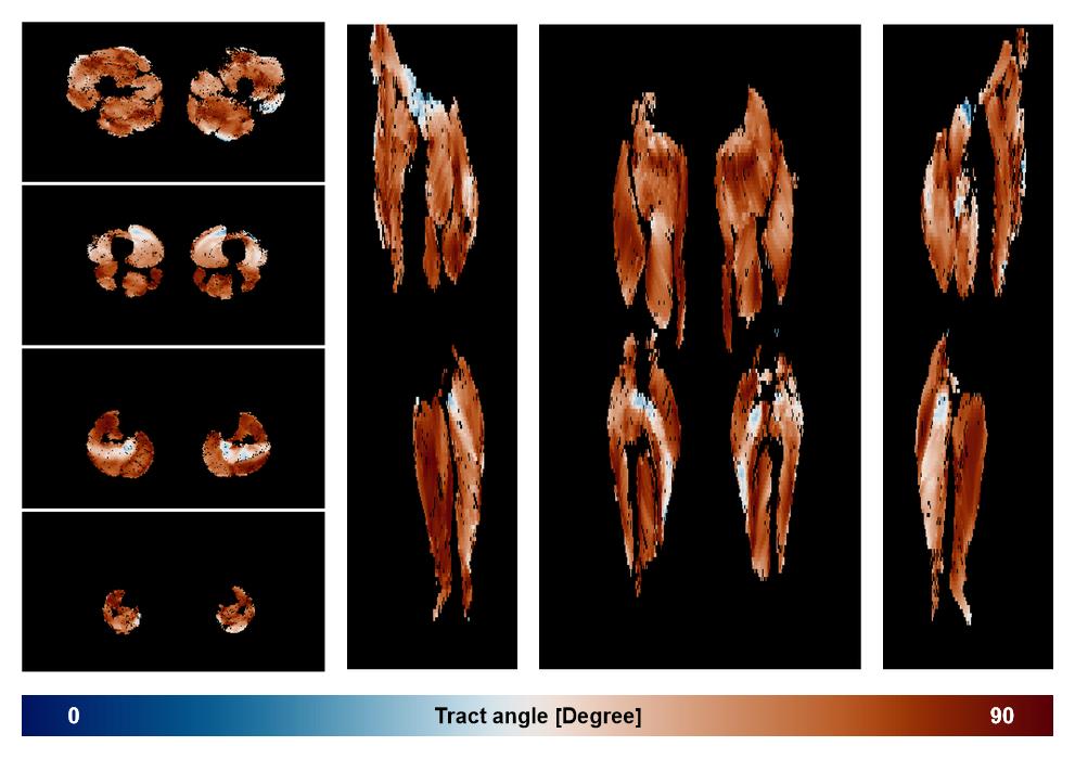 Muscle fiber tract angle map based on whole leg DTI based fiber tractography.