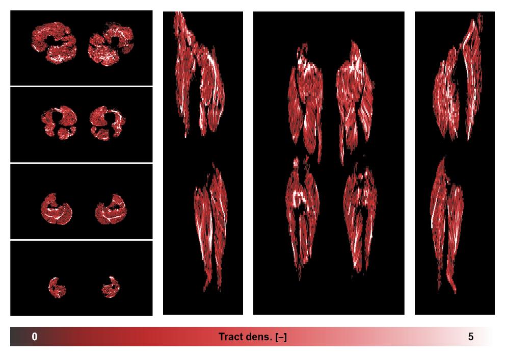 Muscle fiber tract density map based on whole leg DTI based fiber tractography.