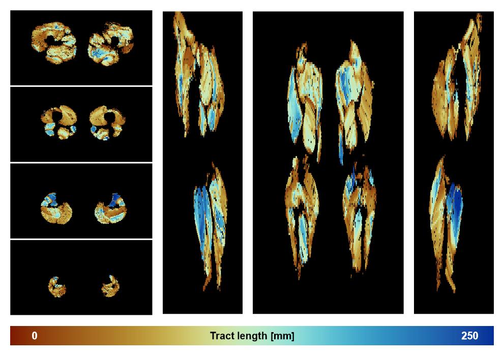 Muscle fiber tract length map based on whole leg DTI based fiber tractography.