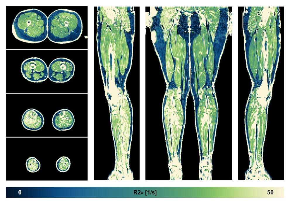 The R2 star relaxation time of the lower extremity obtained from the dixon reconstruction for muscle water fat quantification.